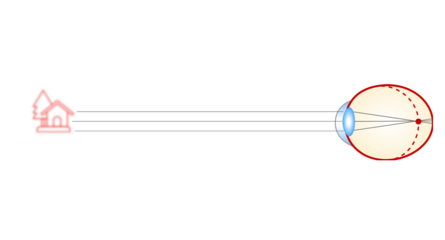 Schematische Darstellung der Kurzsichtigkeit